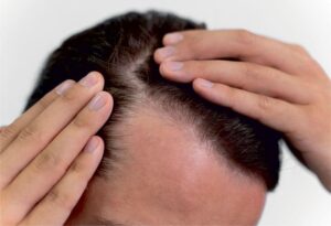 hair fall treatments.jpg